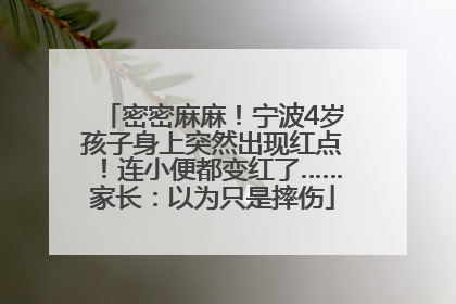 密密麻麻！宁波4岁孩子身上突然出现红点！连小便都变红了……家长：以为只是摔伤